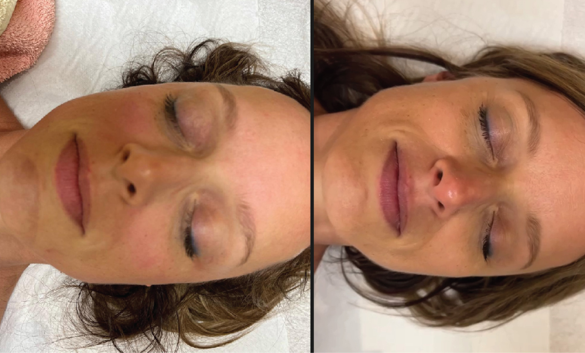 Myofasziale Gesichtsmassage